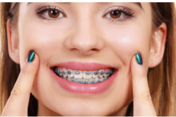 Beneficiile aparatului dentar despre care probabil nu stiai