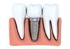 De ce sunt implanturile dentare o soluție potrivită chiar dacă este mai costisitoare